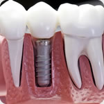 How to Prevent Dental Caries