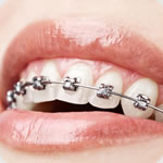 How to Prevent Dental Caries