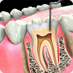 How to Prevent Dental Caries