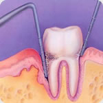 How to Prevent Dental Caries