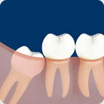 How to Prevent Dental Caries